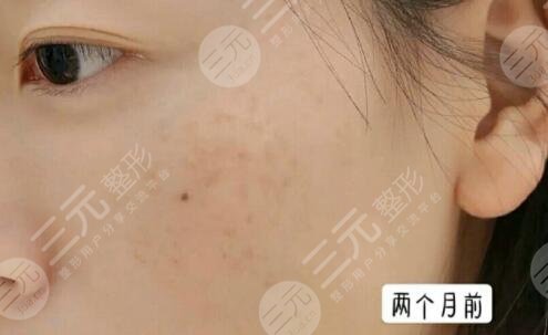 上海第一人民医院祛斑案例分享