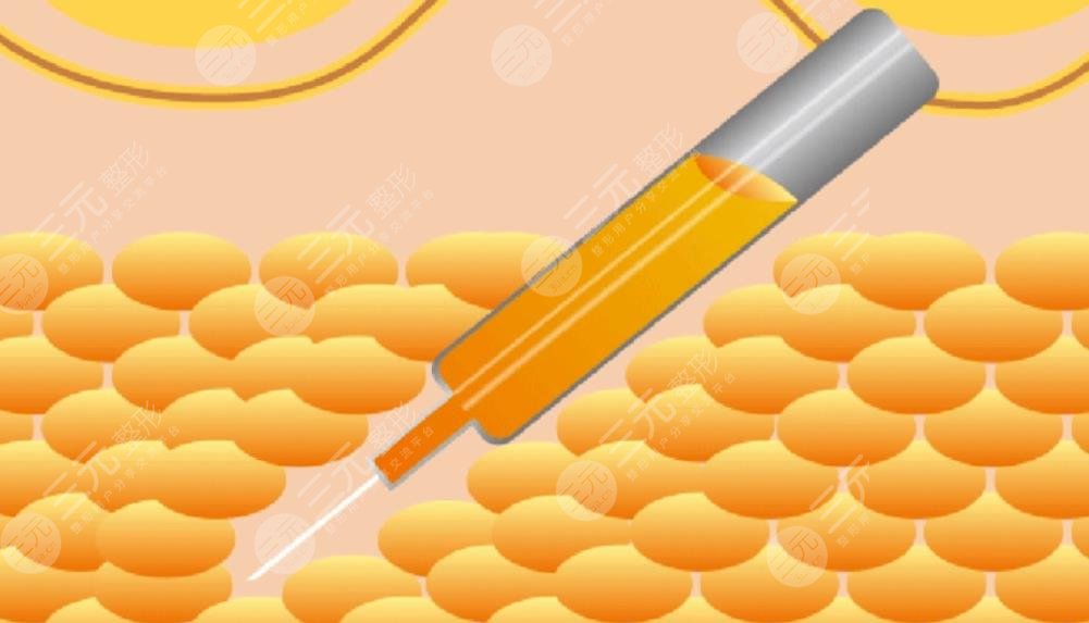 张朋医生面部吸脂案例