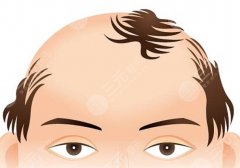 植发的适宜年龄是多少岁？术前科普常识，必看！