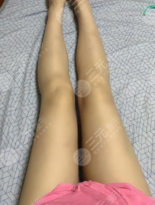 北京世纪坛医院整形美容科吸脂瘦腿案例