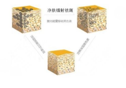 镭射净肤仪祛斑会反弹吗