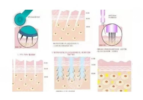 镭射净肤仪祛斑会反弹吗
