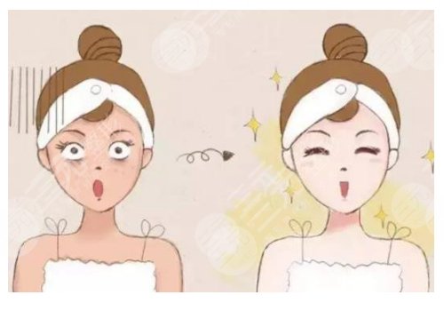 镭射净肤仪祛斑会反弹吗