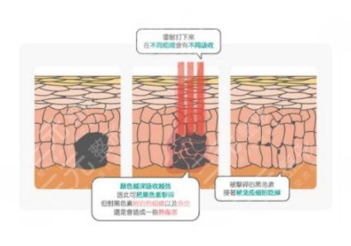 镭射净肤仪祛斑会反弹吗