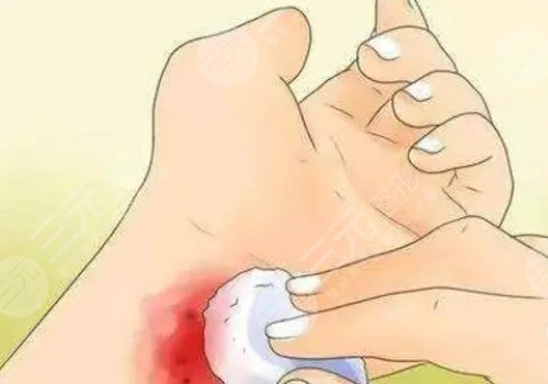 镭射净肤仪祛斑有副作用吗？