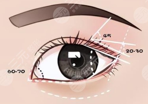 杨瑞年双眼皮失败案例