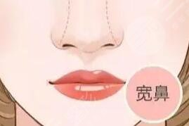 隆鼻