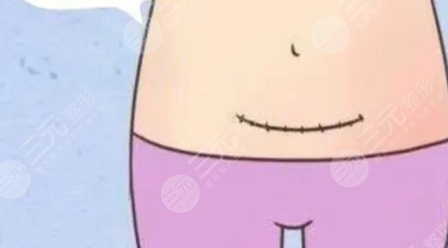 剖腹产疤痕