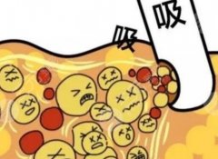 现在吸脂哪种技术好?3种不同技术介绍,瘦身必备指南! 现在吸脂哪种技术好?3种不同技术介绍,瘦身必备指南!
