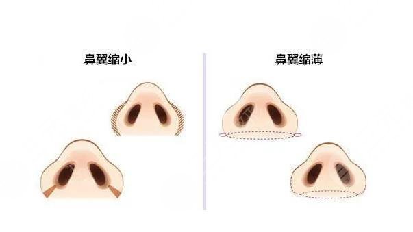 李哲权医生缩?鼻翼怎么样