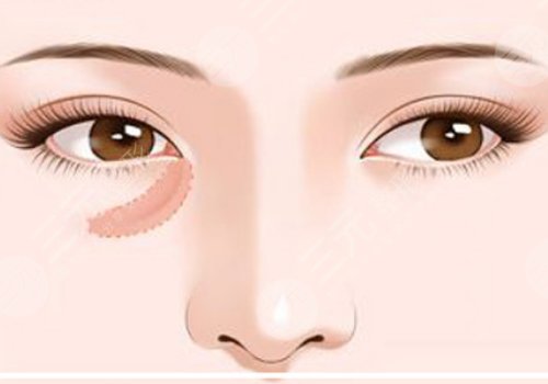 脂肪填充泪沟5到10天照片案例