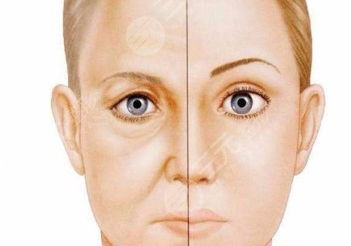 脂肪填充泪沟5到10天照片案例分享来啦