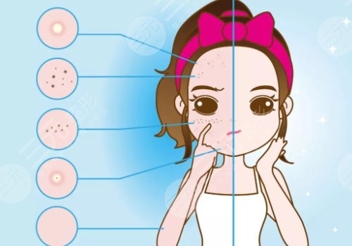 镭射净肤仪祛斑一次有效果吗