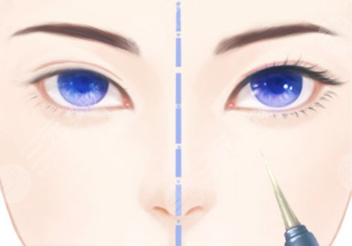 昆明李韬双眼皮案例