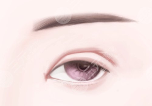 庄蔚强医生双眼皮案例