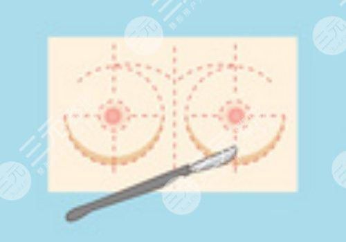 曼托假体好不好？