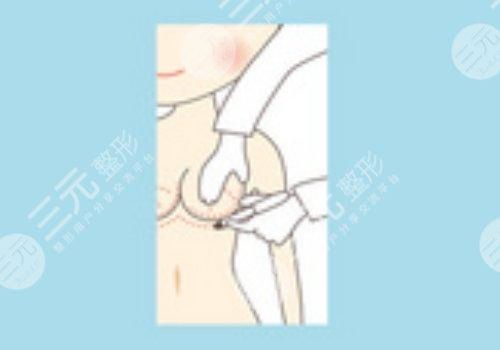 曼托假体好不好？