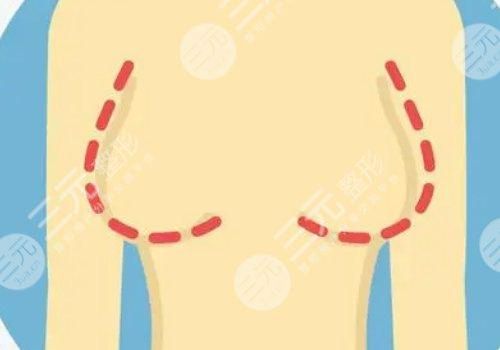 曼托假体好不好？