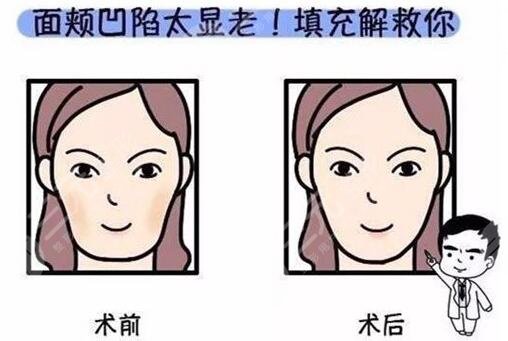 填充面部整形要多少钱?价格表汇总!3种常用材料对比,必看~