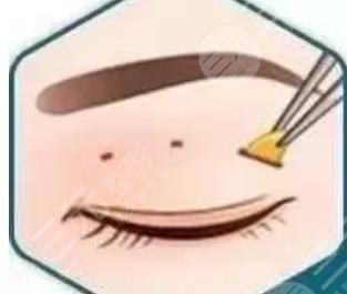 双眼皮