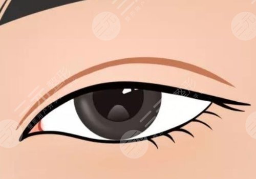 夏国兴割双眼皮怎么样