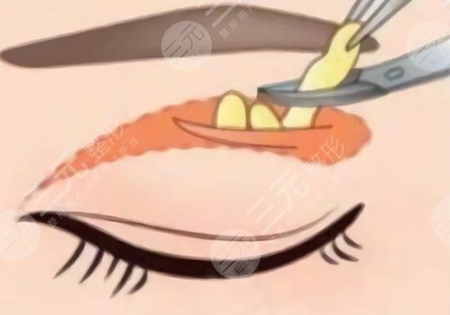 夏国兴割双眼皮怎么样