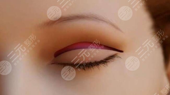 双眼皮