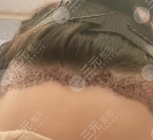 武汉同济医院植发科发际线移植案例分享