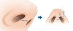 鼻头鼻翼缩小对比图解！手术过程、原理、费用汇总！
