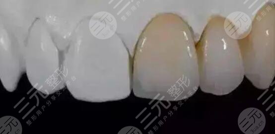 全瓷牙