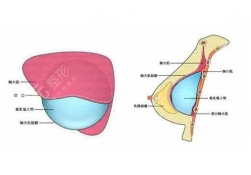 威宁花样年华假体怎么样