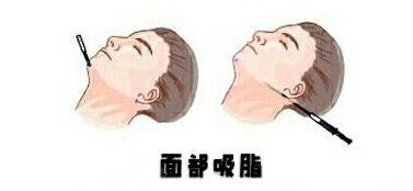 面部吸脂