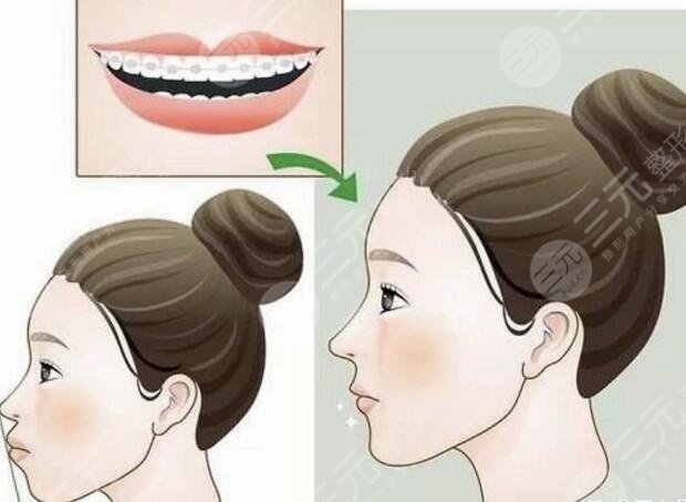 北京大学第三医院牙齿正畸案例参考