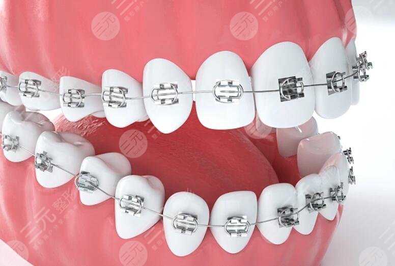 北京大学第三医院牙齿正畸案例参考
