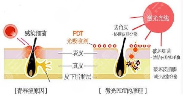 上海六院激光去痘坑手术