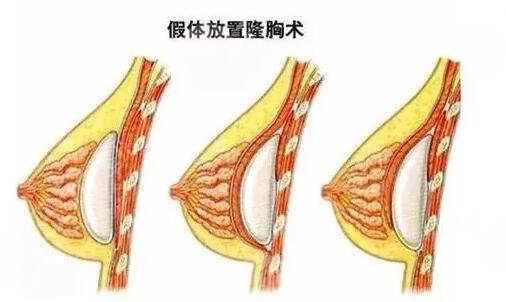 威宁花样年华假体怎么样?