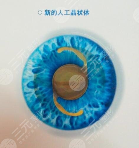双焦人工晶体价格多少钱?2023年均价5800~12,000元不等!