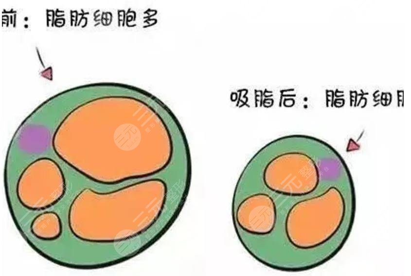 彭才学医生吸脂案例