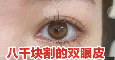 上海第十人民医院割双眼皮案例参考