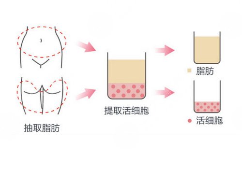 额头填充有风险吗