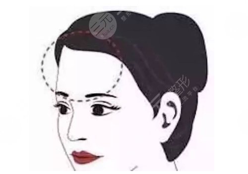 额头填充有风险吗