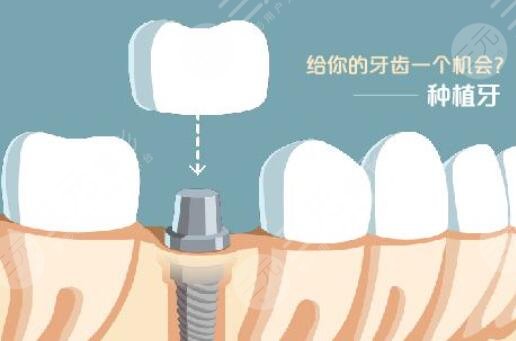 牙齿种植