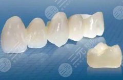 300元1颗的烤瓷牙图片介绍，牙齿修复材料科普！