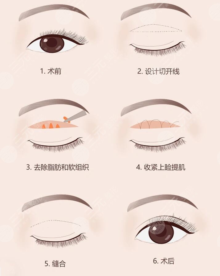 中山医院施越冬双眼皮案例参考