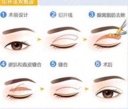 闫迎军双眼皮手术特色