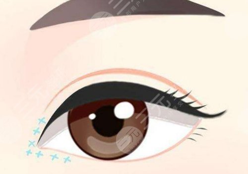 张家口维多利亚做开眼角手术怎么样