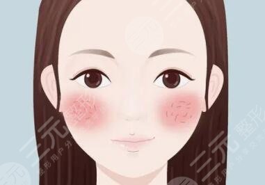 去红血丝
