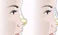 朝天鼻如何矫正？整形方法科普，美鼻攻略从此开始！