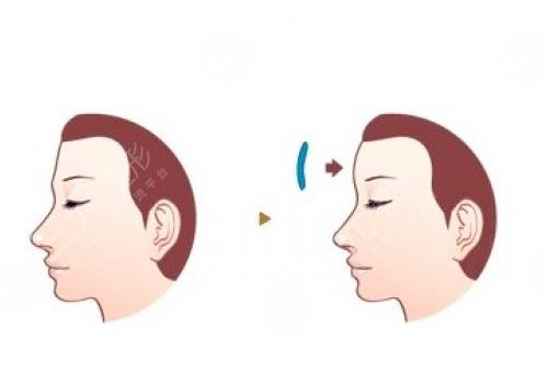 额头填充一般维持多久