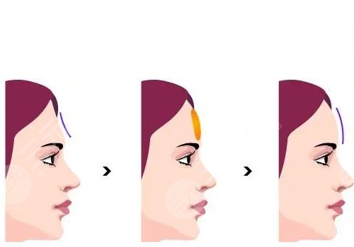 额头填充一般维持多久